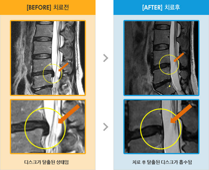 자생한방병원 치료사례 MRI로 보는 치료결과-허리와 왼쪽 다리 바깥쪽으로 통증