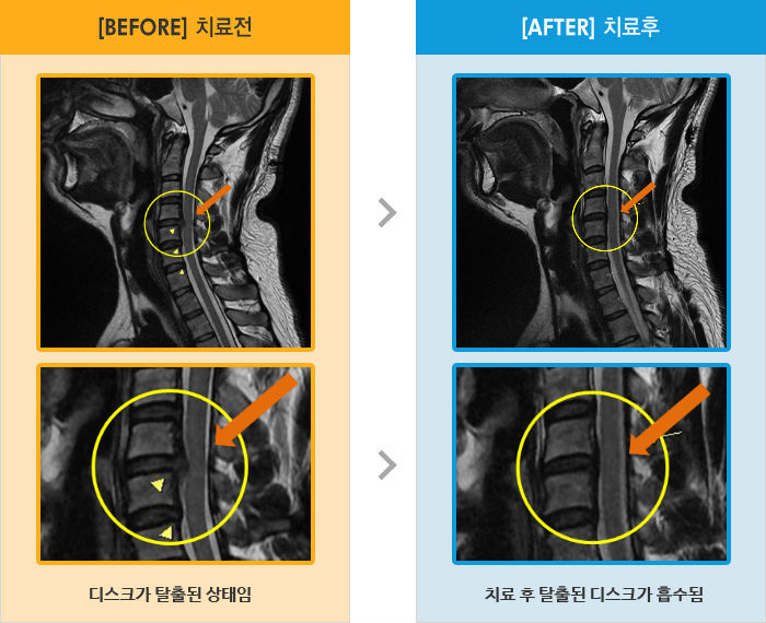 자생한방병원 치료사례 MRI로 보는 치료결과-목과 양쪽 어깨 통증 및 팔 저림