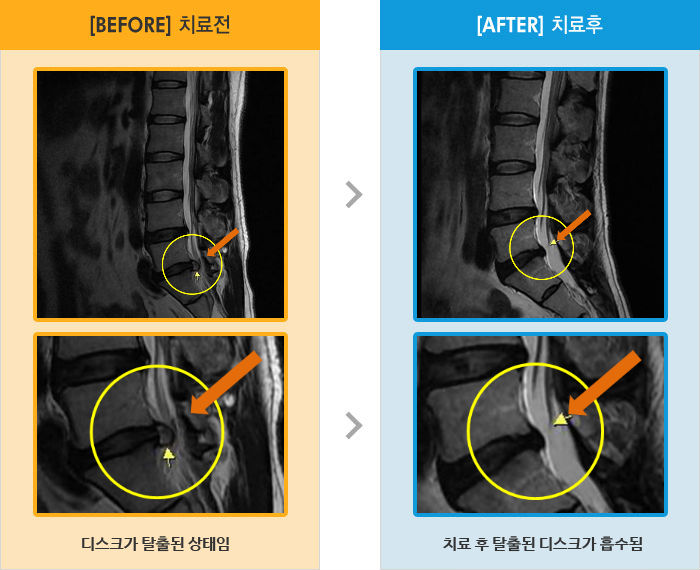 자생한방병원 치료사례 MRI로 보는 치료결과-보행시 무릎 뒤로 당김 증상, 누워있어도 왼쪽 엉덩이에서 무릎까지 저림 증상