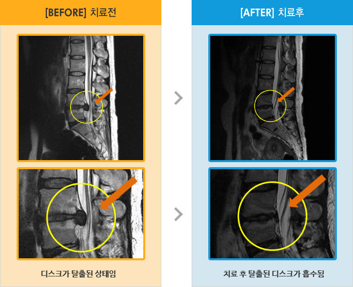 자생한방병원 치료사례 MRI로 보는 치료결과-허리와 오른쪽 다리 통증