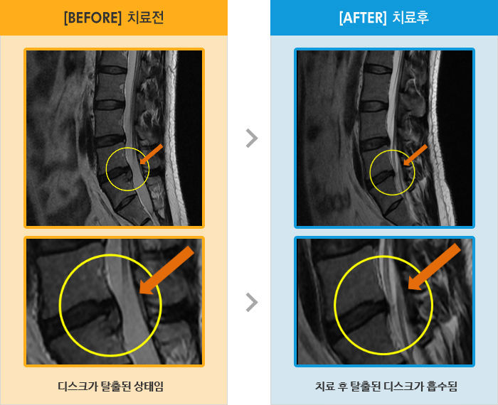 자생한방병원 치료사례 MRI로 보는 치료결과-걸으면 왼쪽 허리 통증이 있고 통증 때문에 잘 때 불편