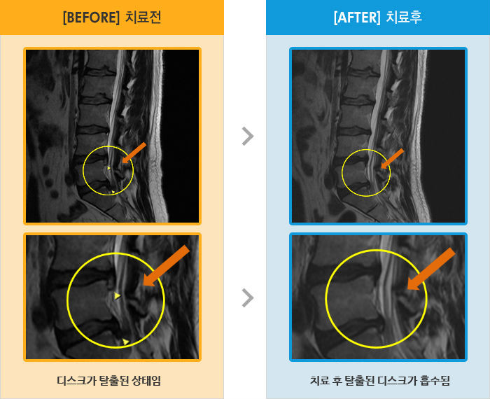 자생한방병원 치료사례 MRI로 보는 치료결과-허리디스크로 인한 통증으로 내원