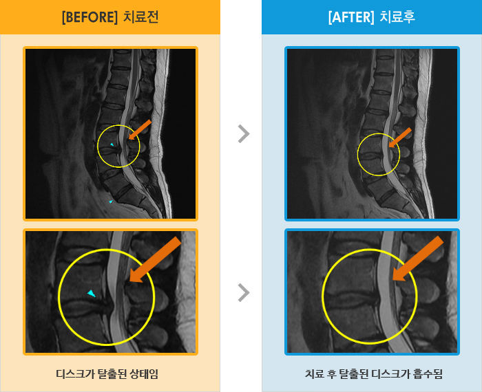 자생한방병원 치료사례 MRI로 보는 치료결과-허리 통증과 오른쪽 엉치, 허벅지 저림