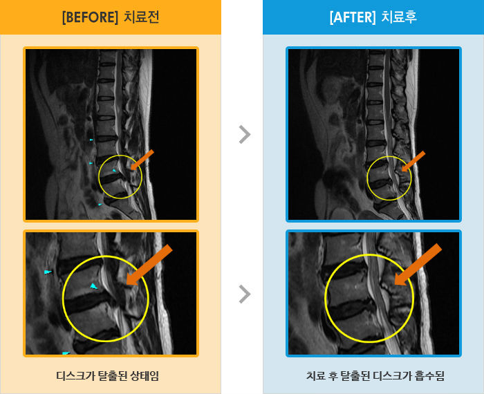 자생한방병원 치료사례 MRI로 보는 치료결과-오른쪽 엉치 통증과 다리 저림