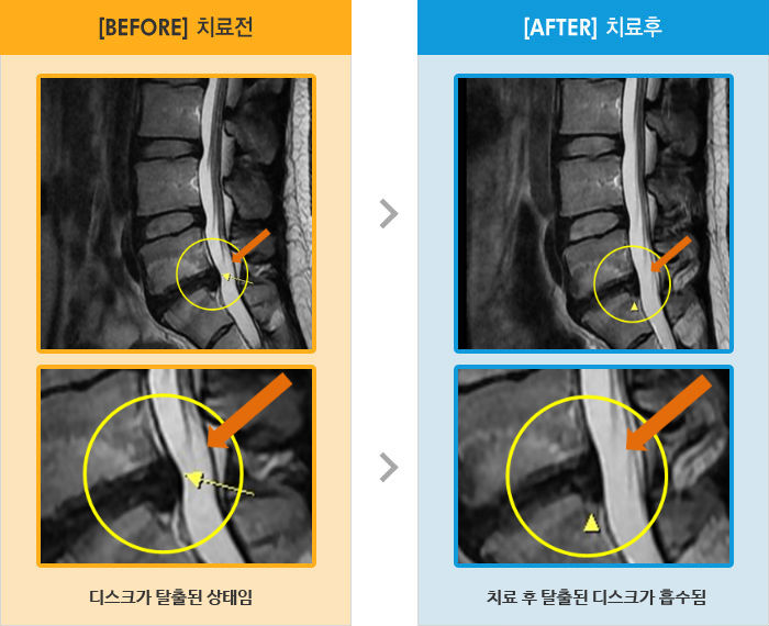 자생한방병원 치료사례 MRI로 보는 치료결과-허리와 왼쪽 골반 통증