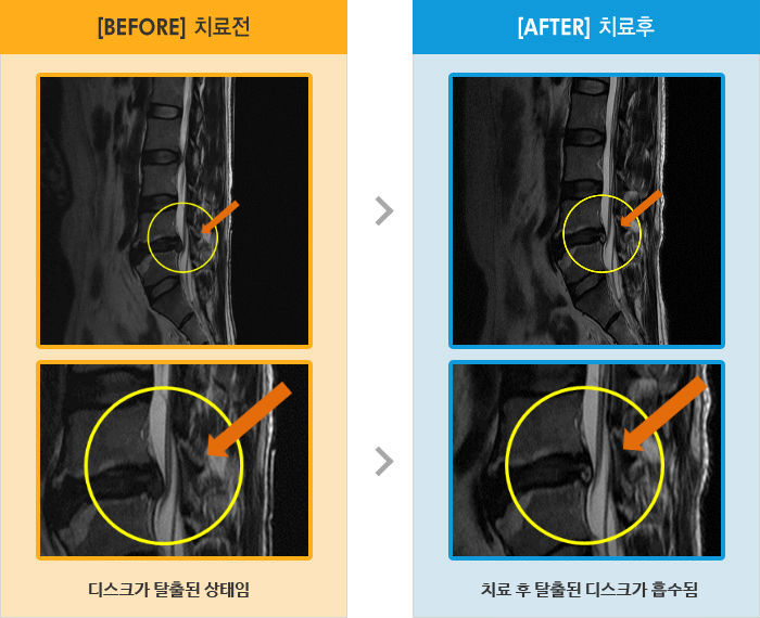 자생한방병원 치료사례 MRI로 보는 치료결과-허리 통증으로 앉았다 일어설 때 통증