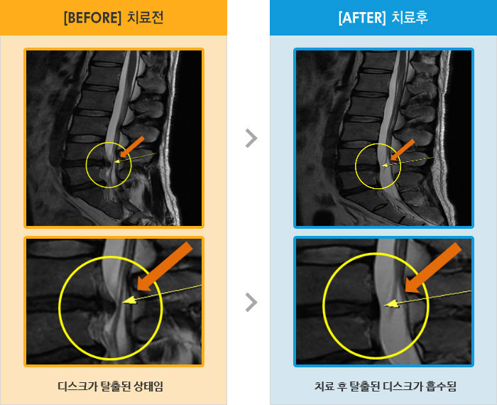 자생한방병원 치료사례 MRI로 보는 치료결과-허리 통증과 양쪽 다리 당김