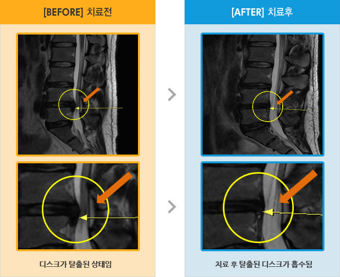 자생한방병원 치료사례 MRI로 보는 치료결과-보행시 우측 골반 통증과 좌측굴 증상