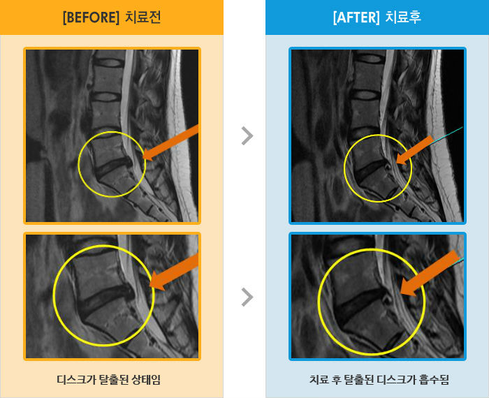 자생한방병원 치료사례 MRI로 보는 치료결과-하부 요추부 통증, 보행시 꼬리뼈 통증, 오래 앉아있으면 다리 저림
