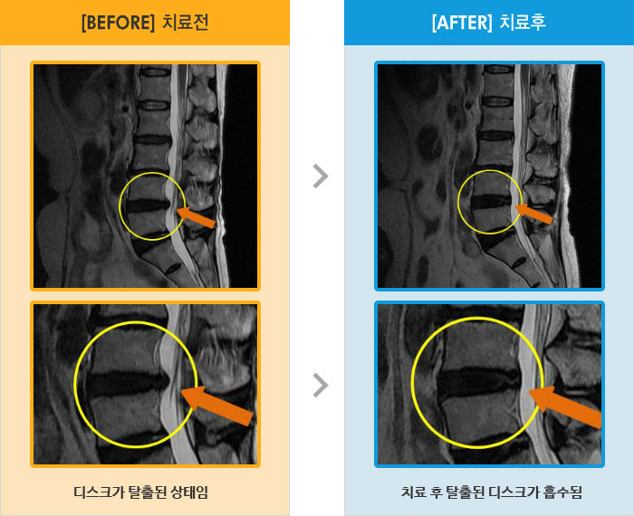 자생한방병원 치료사례 MRI로 보는 치료결과-허리가 아프고 왼쪽 허벅지 종아리가 앉으면 통증