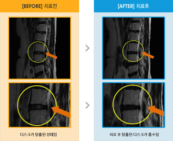 자생한방병원 치료사례 MRI로 보는 치료결과-우측 다리 통증과 함께 허벅지 뒤로 방사통, 저림