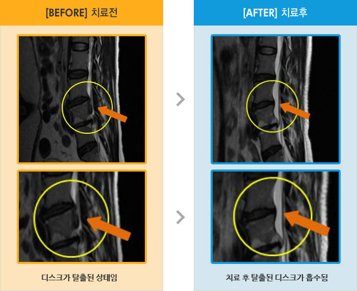 자생한방병원 치료사례 MRI로 보는 치료결과-오른쪽 허리 골반 통증이 있으며 엉치 종아리쪽 마비감