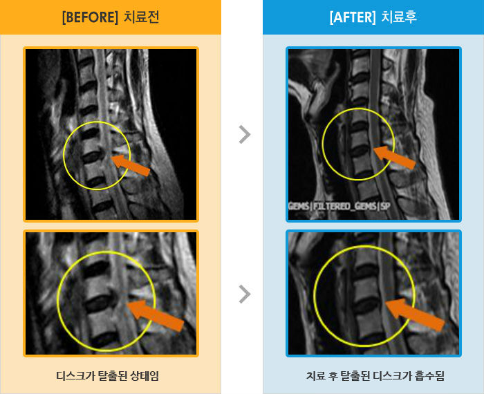 자생한방병원 치료사례 MRI로 보는 치료결과-왼쪽 팔을 내리면 통증 및 손끝 저림