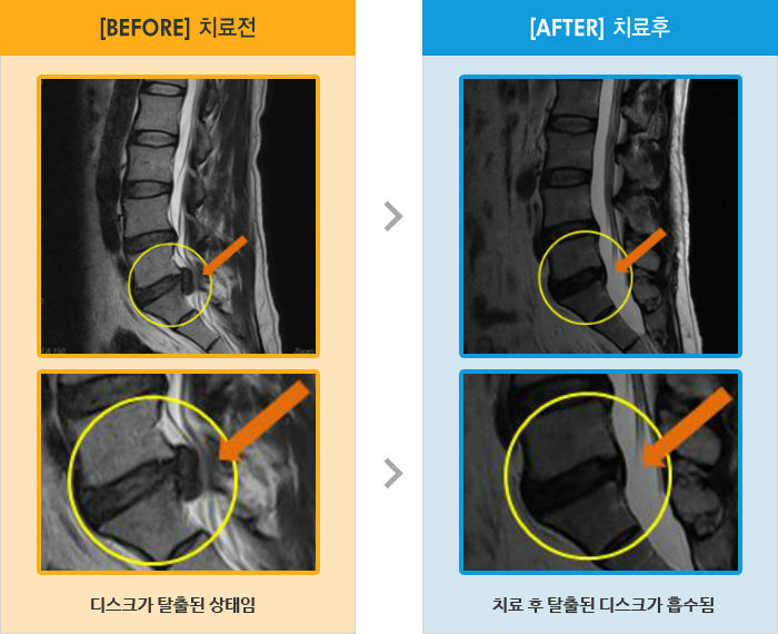 자생한방병원 치료사례 MRI로 보는 치료결과-양측 다리 통증, 허리 숙이면 통증이 느껴짐