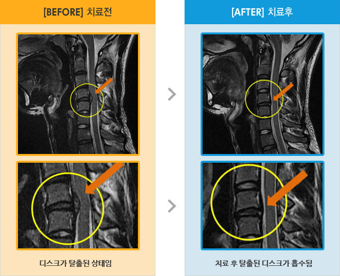 자생한방병원 치료사례 MRI로 보는 치료결과-목 통증, 왼쪽 어깨부터 팔 저림