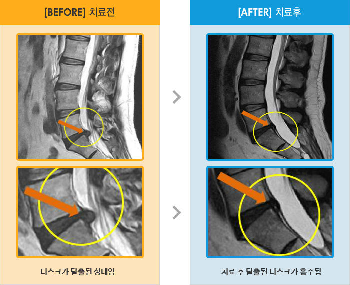 자생한방병원 치료사례 MRI로 보는 치료결과-오른쪽 허리 아래와 골반 통증