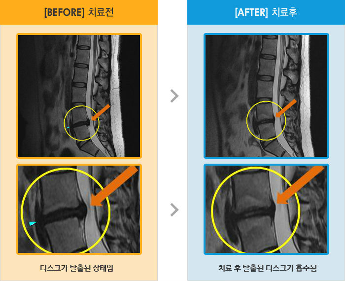 자생한방병원 치료사례 MRI로 보는 치료결과-양측 허리 엉치 통증 및 다리 저림, 당김