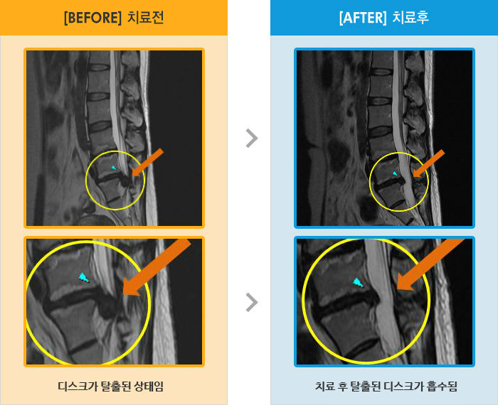 자생한방병원 치료사례 MRI로 보는 치료결과-허리 통증 및 왼쪽 엉치 다리에 통증