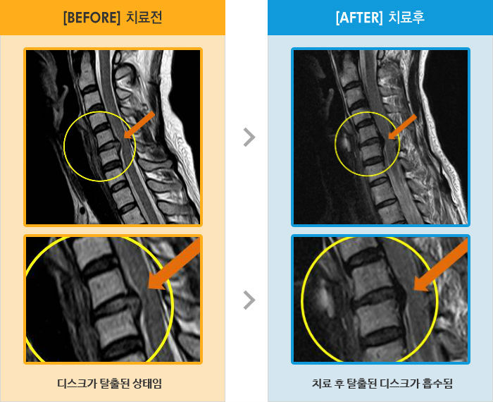 자생한방병원 치료사례 MRI로 보는 치료결과-목부터 양어깨 손가락까지 저림, 야간통