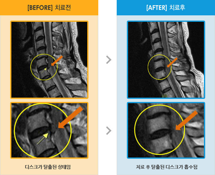 자생한방병원 치료사례 MRI로 보는 치료결과-우측팔 통증으로 팔을 위로 올리고 있다.