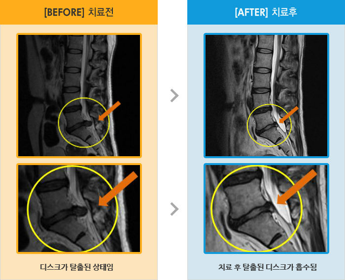 자생한방병원 치료사례 MRI로 보는 치료결과-오른쪽 다리 뒤로 당기고 앉기 걷을 시 통증