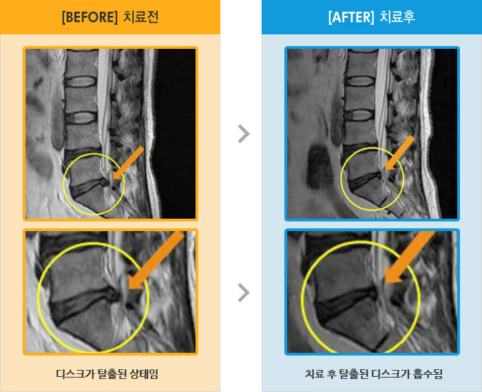 자생한방병원 치료사례 MRI로 보는 치료결과-앉아있으면 허리 통증, 왼쪽 새끼발가락 감각 무딤