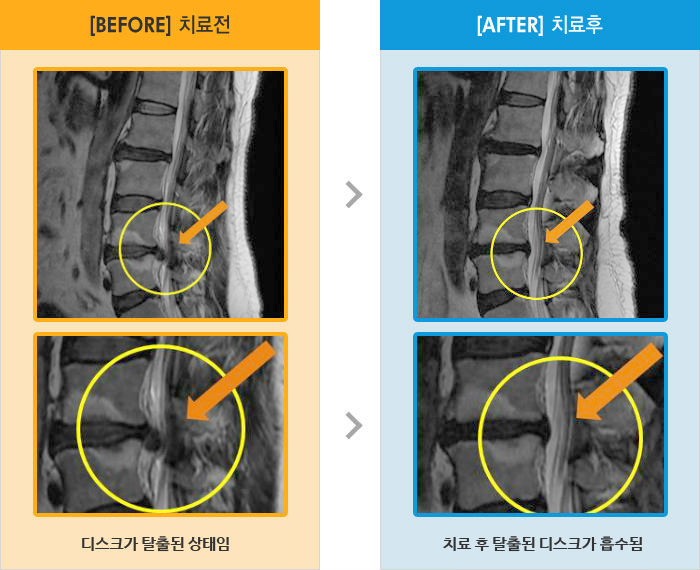 자생한방병원 치료사례 MRI로 보는 치료결과-허리부터 좌측 하지 발바닥까지 통증으로 내원했다.