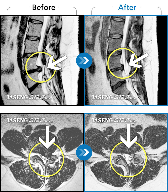 자생한방병원 치료사례 MRI로 보는 치료결과-좌측 허리, 골반, 다리 바깥쪽으로 통증과 저림