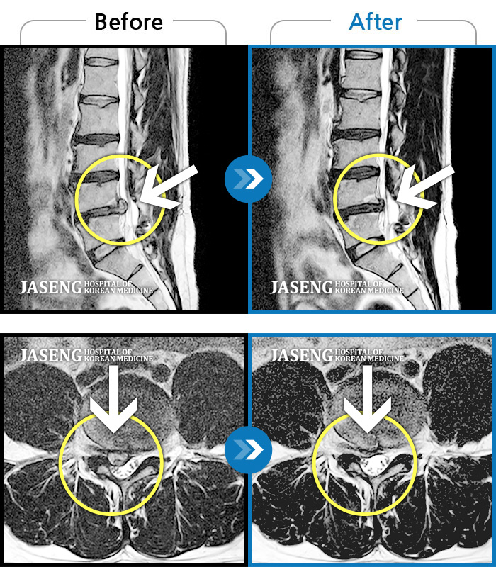 자생한방병원 치료사례 MRI로 보는 치료결과-허리와 우측 고관절에서 다리, 발목까지 통증과 저림 심해요.