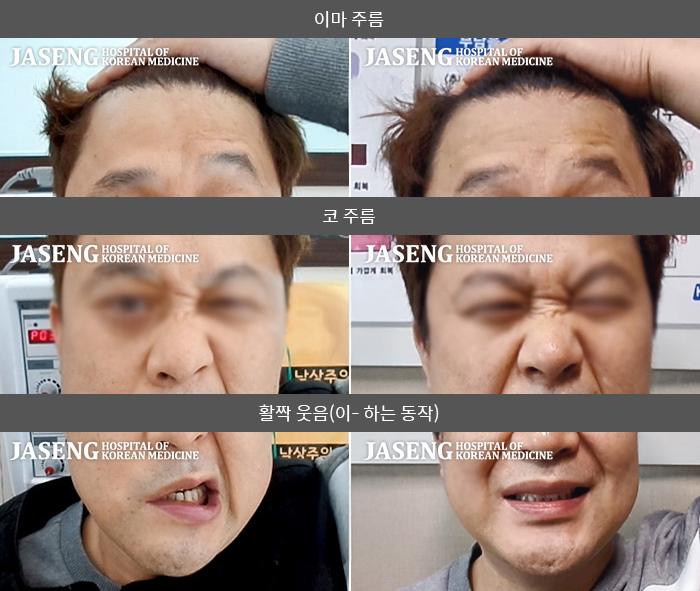 자생한방병원 치료사례 MRI로 보는 치료결과-귀 뒤가 아프다가 눈물이 나오고 물 마실때 입에서 새어 나온다.