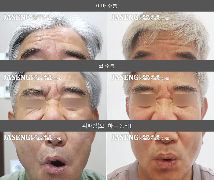 자생한방병원 치료사례 MRI로 보는 치료결과-극심한 스트레스 후 입에서 물이 새고 눈이 안감긴다. 