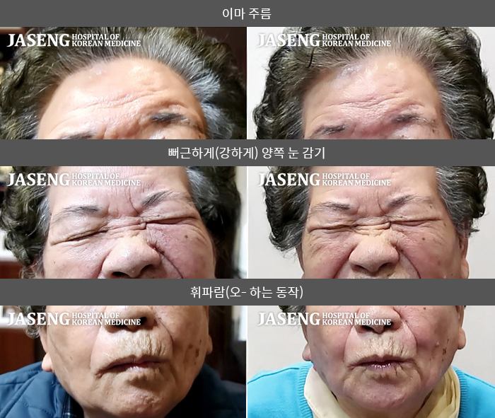자생한방병원 치료사례 MRI로 보는 치료결과-당뇨가 심한 84세 고령의 안면마비
