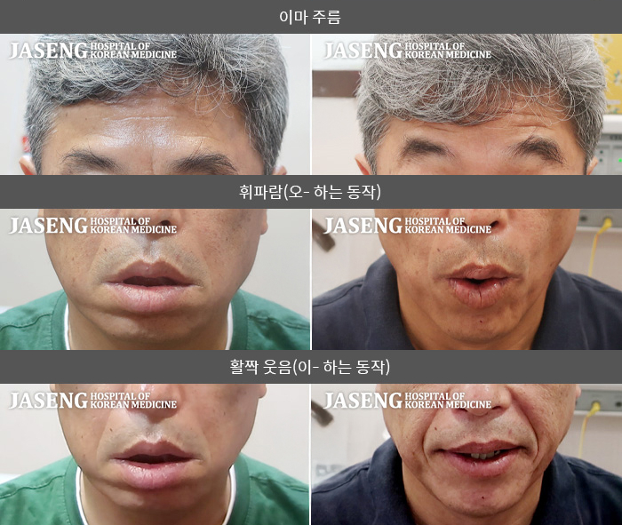 자생한방병원 치료사례 MRI로 보는 치료결과-코로나 백신 접종 후 발생한 양측성 안면마비로 아랫입술 전체를 움직일 수 없었음