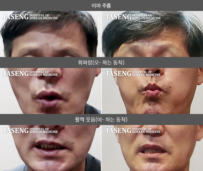 자생한방병원 치료사례 MRI로 보는 치료결과-급성 뇌경색 후 발생한 중추성 좌측 안면마비