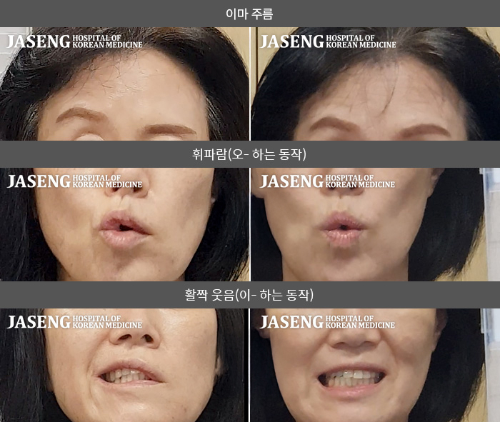 자생한방병원 치료사례 MRI로 보는 치료결과-왼쪽 눈이 잘 안 감기고 왼쪽 안면부 전체 마비된 느낌이다. 