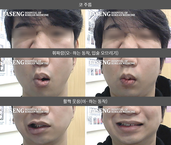 자생한방병원 치료사례 MRI로 보는 치료결과-좌측 눈이 안감기고 눈물이 나고  좌측 귀 뒤가 아프면서  좌측으로 입이 마비됨