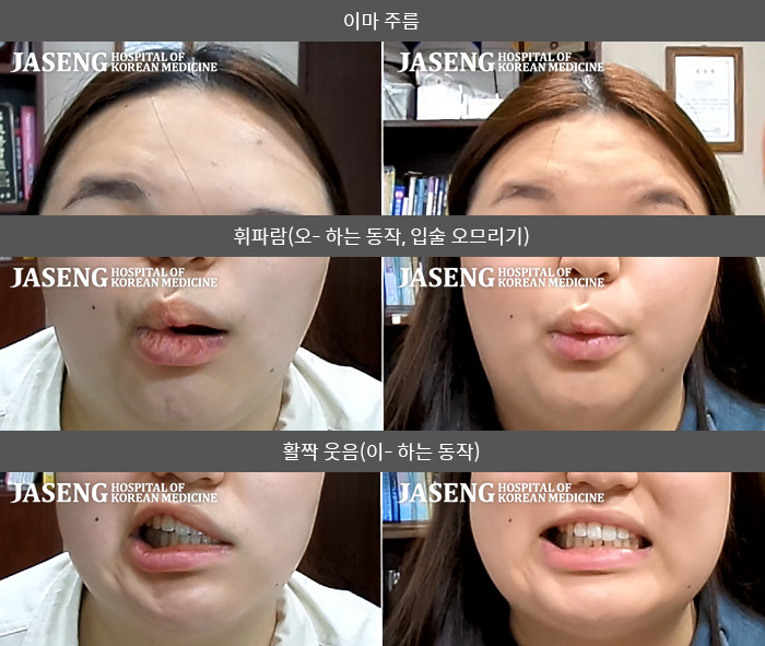 자생한방병원 치료사례 MRI로 보는 치료결과-반대편으로 재발된 안면마비