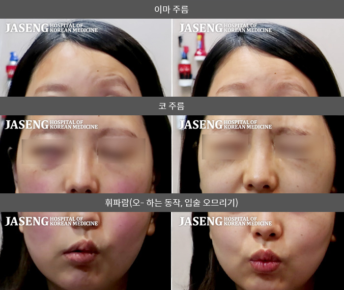 자생한방병원 치료사례 MRI로 보는 치료결과-임신 15주에 발생한 대상포진을 동반한 안면마비가 6주 만에 완치