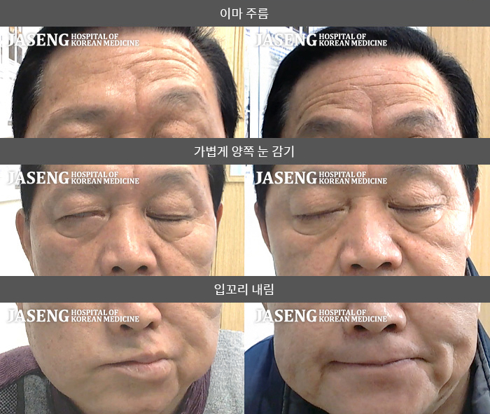 자생한방병원 치료사례 MRI로 보는 치료결과-오른쪽 눈이 안감기고 시리며 귀뒤 통증이 있다.