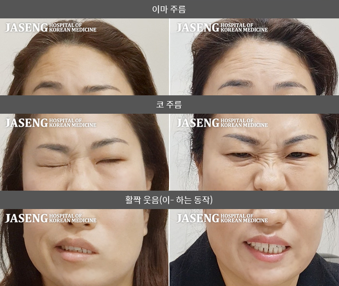 자생한방병원 치료사례 MRI로 보는 치료결과-좌측 안면부 마비로 이마 주름 잡히지 않음. 발음이 안되고 음식물 섭취 시 비대칭으로 진행