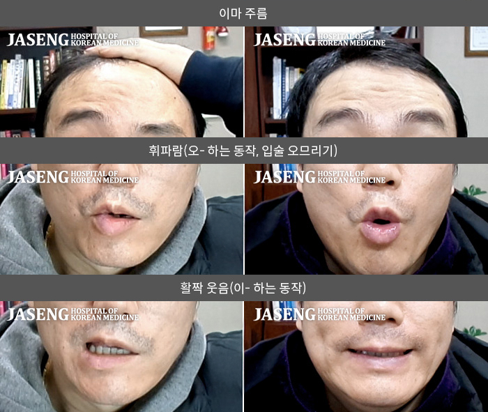 자생한방병원 치료사례 MRI로 보는 치료결과-좌측 안면 마비로 내원함