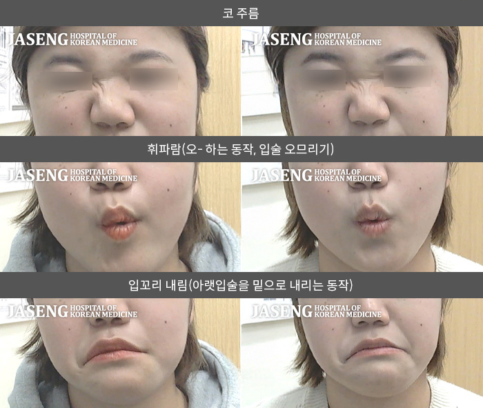 자생한방병원 치료사례 MRI로 보는 치료결과-안면마비 발생 5일전부터 왼쪽 귀뒤통증이 발생한 후 좌측 눈감기가 부자연스럽고 입이 마비되어 불편함 