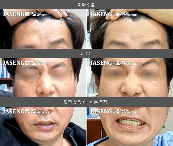 자생한방병원 치료사례 MRI로 보는 치료결과-과로 누적으로 인한 우측 안면 마비