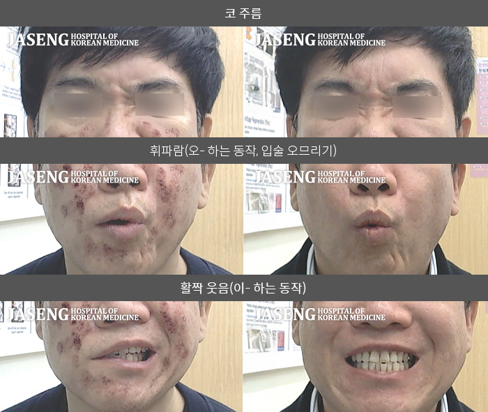 자생한방병원 치료사례 MRI로 보는 치료결과-우측 눈이 안감기고 입주위가 오른쪽이 마비되어 왼쪽으로 돌아가 양치할 때 물이 새고 물을  마실 때도 물이 새서 흐름