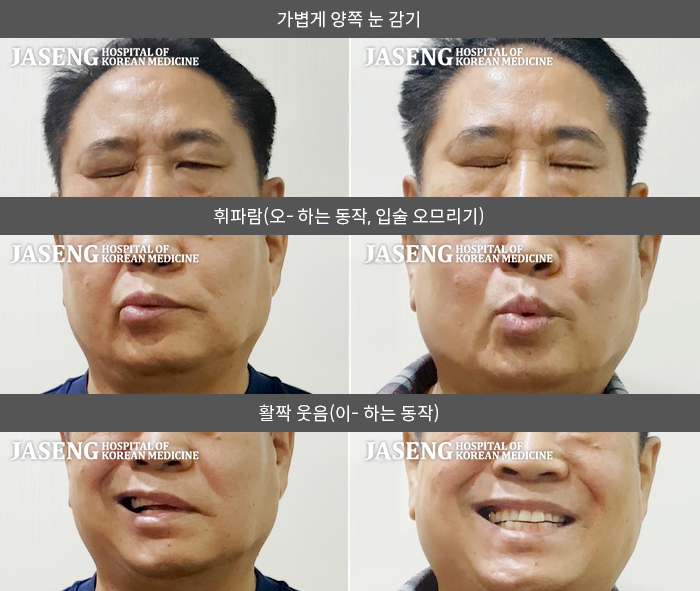 자생한방병원 치료사례 MRI로 보는 치료결과-1주일 정도 무리한 후 발생한 안면마비, 더 심해진 2일차에 입이 비뚤어져 내원