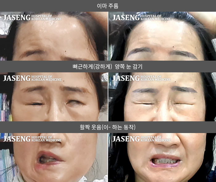 자생한방병원 치료사례 MRI로 보는 치료결과-안면근육의 뭉침 증상이 지속