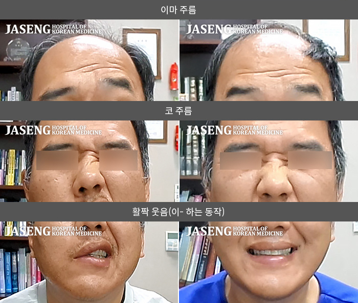 자생한방병원 치료사례 MRI로 보는 치료결과-미각저하와 청각과민의 증상이 약간 동반된 상태였다.