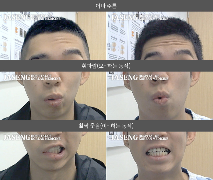 자생한방병원 치료사례 MRI로 보는 치료결과-우측안면마비 급성적으로 발생, 눈감기 어렵고  입술움직임 저하