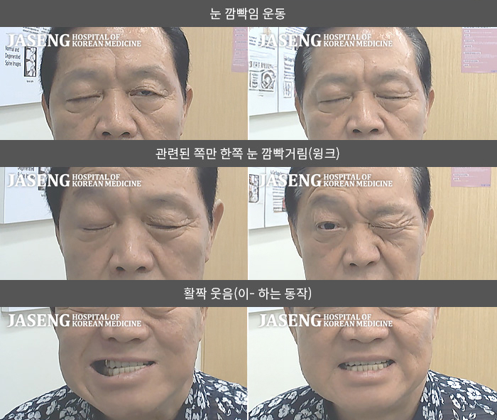 자생한방병원 치료사례 MRI로 보는 치료결과-2020년 발병해서 본원 치료 했지만 2023년 스트레스도 재발병했습니다.