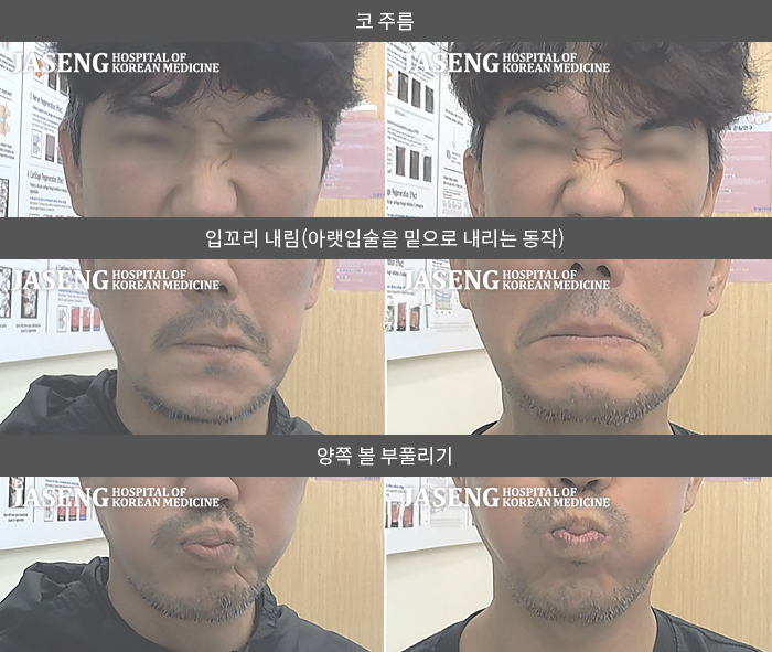 자생한방병원 치료사례 MRI로 보는 치료결과-1개월 전부터 수면시간 부족  2시간만 수면상태에서 감기 이환되어 안면마비 발생 